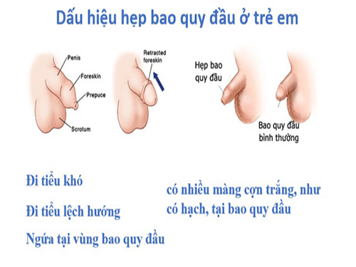 Những bệnh khi hẹp bao quy đầu - Dài bao quy đầu có nên cắt không