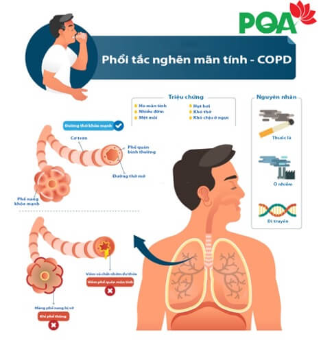 Sự mật thiết của Suy dinh dưỡng và Bệnh phổi tắc nghẽn mãn tính