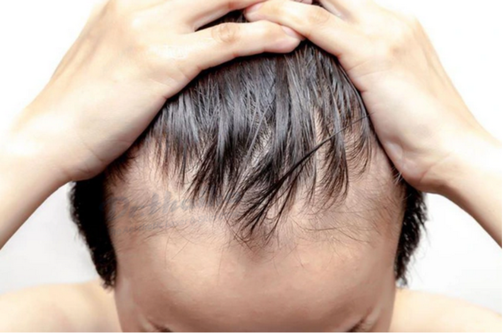 Tóc rụng nhiều và thưa ở nam giới do lối sinh hoạt không lành mạnh